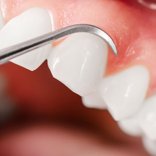 歯周病の原因となる歯垢（プラーク）を除去